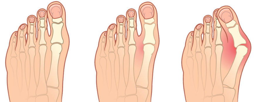 foot pain and toe separators