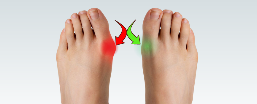 How to Get Rid of Bunions Without Surgery